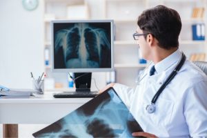 What causes Mesothelioma Cancer : In-Depth Insight